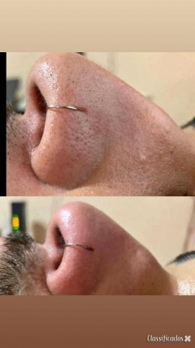 Depilação Masculina